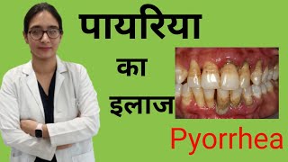 pyorrhea treatment at homeपायरिया का घरेलू इलाज  cure of pyorrheaperiodontitis treatment [upl. by Limaa249]