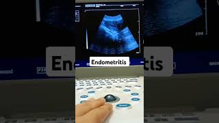 endometritis seen ultrasound fetalheartrate loveultrasound shortvideo foryou [upl. by Rawlinson412]