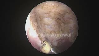 coblation adenoids boundaries defined [upl. by Lupe]