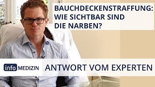 Bauchdeckenstraffung Sichtbare Narben  Expertenantwort von Dr Kiermeir [upl. by Cosmo]