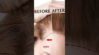 Minoxidil 1052 Mintop  Hair lossHair ReGrowBaldness Doctor Meds Uses In HindiampEngSub [upl. by Ahsinawt]