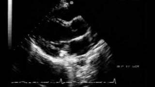 mitral valve prolapse and mitral annular calcification [upl. by Fabiolas]