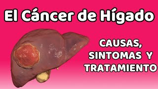 CÁNCER DE HÍGADO Causas signos y síntomas diagnóstico y tratamiento [upl. by Letnoj]