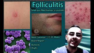 Folliculitis Symptoms causes and treatment [upl. by Rebah358]