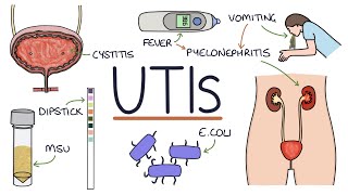 Understanding Urinary Tract Infections [upl. by Arakihc]