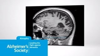 What is posterior cortical atrophy [upl. by Isborne]