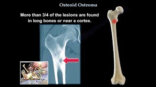 Osteoid Osteoma  Everything You Need To Know  Dr Nabil Ebraheim [upl. by Arretnahs981]