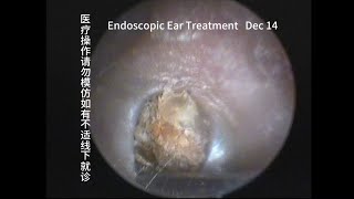 Blackhead cleaning in the external ear canal 20231214 [upl. by Glynnis]