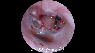 Double Traumatic Tympanic Membrane  Eardrum  Perforation [upl. by Grissom]