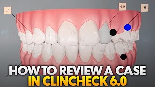 How to Review an Invisalign Case in Clincheck 60 [upl. by Ahsap90]