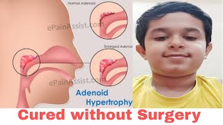 Enlarged Adenoids Hypertrophy Treated without Surgery Operation। Home Remedies । Naturopathy। ENT [upl. by Bogey52]