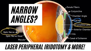 Narrow Angles Does a Laser Peripheral Iridotomy LPI Work [upl. by Adiel]