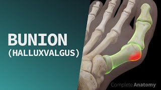 Bunion Hallux Valgus [upl. by Putnam]