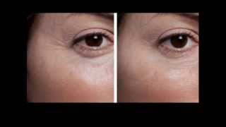 InstantEffect 90 Second Wrinkle Reducer  In Action [upl. by Alegnasor]