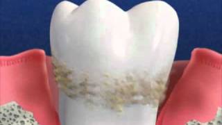 What is Alternative to Periodontal Gum Disease [upl. by Eiroc]