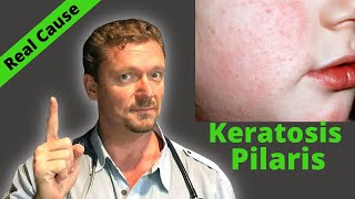 KERATOSIS PILARIS Fix Sign of Serious Condition Chicken Skin Cure [upl. by Ji]