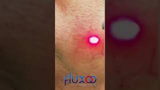 Aplicação com laser em vasinhos da face varizes vasinhos aplicação [upl. by Ydnic600]