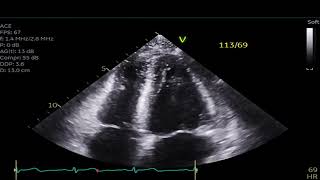 Reverse Stress Cardiomyopathy [upl. by Asenab]