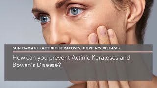 How can you prevent Actinic Keratoses and Bowens Disease [upl. by Hollenbeck]