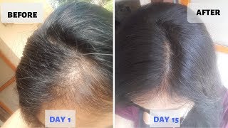 OMG  15 Days Hair Growth Miracle Treatment  Grow Long Thicken Hair  100 works [upl. by Aillicsirp]