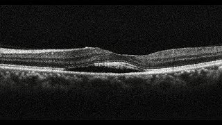 Photodynamic Therapy in Chronic Central Serous Chorioretinopathy  Retina Center Tijuana Mexico [upl. by Anitsyrhk]