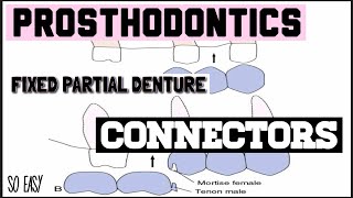 CONNECTORS II RIGID AND NON RIGID II FIXED PARTIAL DENTURE II PROSTHODONTICS [upl. by Yllen]