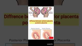 Difference between anterior placenta posterior placenta  anterior  posterior [upl. by Eustace]