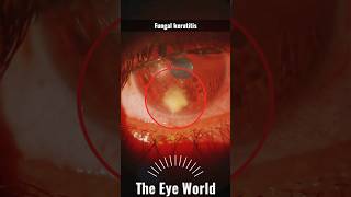 Fungal keratitis [upl. by Sessler365]