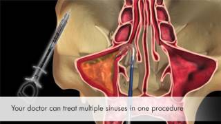 Balloon Sinus Dilation from Entellus [upl. by Champagne]