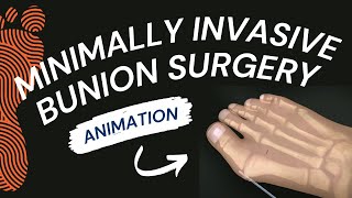 Minimally Invasive Bunion Surgery A Short Animation [upl. by Rianon]