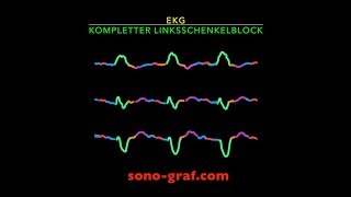 EKG Linksschenkelblock [upl. by Jemy]