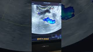 How to diagnose ectopic pregnancy in transvaginal sonography [upl. by Mcclure]