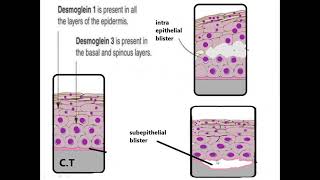 periodontal lecture topic DESQUAMATIVE GINGIVITIS in Hindi [upl. by Yseulta]