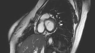 Mitral valve [upl. by Car]