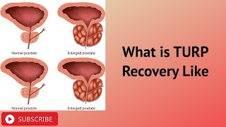 What is TURP Recovery Like [upl. by Timus901]