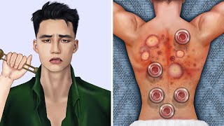 ASMR Cupping Therapy amp Back Acne Removal [upl. by Vladi140]