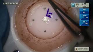 Simple marking and preparation of precut DSAEK graft suture pull through double arm 100 prolene [upl. by Tammara723]