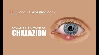 Chalazion  Causes Treatment and Surgery [upl. by Aiynat]