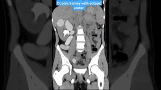 CT scan case 68 Duplex kidney with ectopic ureter ctscan radiology radiologist medicalimaging [upl. by Ynaffat482]