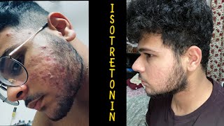 Acne changed my life part 2 isotretinoin benefits and side effects [upl. by Etom]