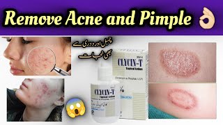 Clycin t lotionclycin t lotion how to useclycin t lotion for acneclycin t lotion uses in urdu [upl. by Kistner]