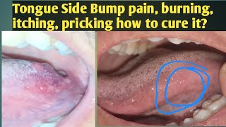 Tongue Side Bump painingHow to Cure Tongue papillae irritationTongue side bump is Itchy pricking [upl. by Earesed]