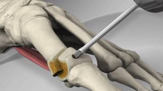 First Metatarsal Distal Chevron Osteotomy with Arthrex® LPS Screw [upl. by Velda343]