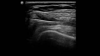 Knee Ultrasound Joint Injection at the Suptrapatellar Recess [upl. by Minni]