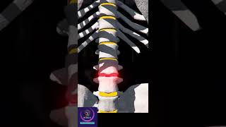 Spinal Cord Pain Management via Intrathecal pump [upl. by Loftis498]