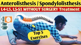 Lumbar Anterolisthesis l5 s1 treatment spondylolisthesis l4l5 exercises in hindi without surgery [upl. by Allveta]