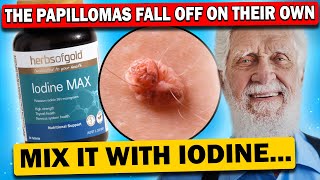 The best recipes for fighting papillomas and warts Thats exactly what doctors do [upl. by Kcod]