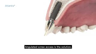 32671392 USX 1804 Atlantis CustomBase solution angulated screw access Installation Subtitles [upl. by Orelie]