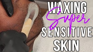 Waxing SUPER Sensitive Skin No Lifting Hirsutism [upl. by Aehsat]