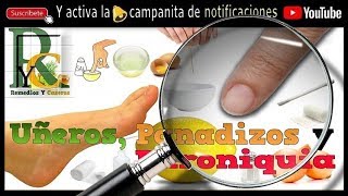 Panadizos 💅 Uñero o uñeros en los pies remedios caseros y tratamiento  Uña encarnada dedo gordo pie [upl. by Allemat]